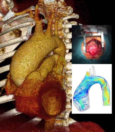 AneurysmTool Project